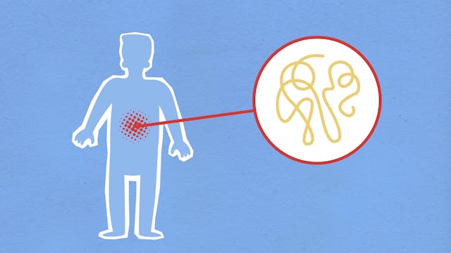 Sketch of a human figure highlighting gut inflammation, representing leaky gut, autoimmune activity, and its role in Hashimoto’s thyroiditis and brain fog.